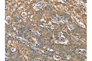 The image on the left is immunohistochemistry of paraffin-embedded Human gastric cancer tissue using ABIN7190368(CSMD1 Antibody) at dilution 1/40, on the right is treated with synthetic peptide. (CSMD1 antibody)