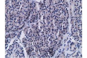 Immunohistochemical staining of paraffin-embedded Carcinoma of Human kidney tissue using anti-CD80 mouse monoclonal antibody. (CD80 antibody)