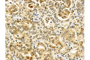 ABIN6259505 and ABIN6275797 at 1/100 staining Human kidney cancer by IHC-P. (CHFR antibody  (Internal Region))