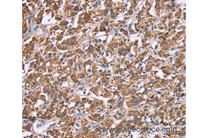 Immunohistochemistry of Human thyroid cancer using HSPE1 Polyclonal Antibody at dilution of 1:40 (HSPE1 antibody)