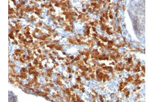 Formalin-fixed, paraffin-embedded human Lymphoma stained with CD79a Monoclonal Antibody (IGA/515).