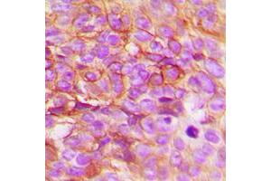 Immunohistochemical analysis of STEAP3 staining in human breast cancer formalin fixed paraffin embedded tissue section. (STEAP3 antibody  (C-Term))