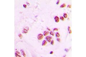 Immunohistochemical analysis of IP6K2 staining in human lung cancer formalin fixed paraffin embedded tissue section. (IP6K2 antibody  (Center))