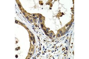 Immunohistochemistry of paraffin-embedded human stomach cancer using CTSS antibody at dilution of 1:200 (400x lens). (Cathepsin S antibody)