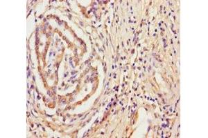 Immunohistochemistry of paraffin-embedded human pancreatic cancer using ABIN7166456 at dilution of 1:100 (TPST2 antibody  (AA 26-377))