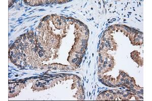 Immunohistochemical staining of paraffin-embedded Adenocarcinoma of Human ovary tissue using anti-EIF2S1 mouse monoclonal antibody. (EIF2S1 antibody)