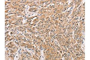 The image on the left is immunohistochemistry of paraffin-embedded Human prostate cancer tissue using ABIN7131608(WNT11 Antibody) at dilution 1/20, on the right is treated with fusion protein. (WNT11 antibody)