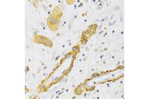 Immunohistochemistry of paraffin-embedded human liver cancer using KIF1B Antibody (ABIN5973994) at dilution of 1/100 (40x lens). (KIF1B antibody)