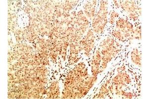Immunohistochemical analysis of paraffin-embedded Human Breast Carcinoma Tissue using Acetyl NF kB P65(K314/K315) Mouse mAb diluted at 1:200. (NF-kB p65 antibody  (acLys314, acLys315))