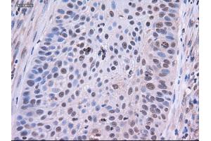 Immunohistochemical staining of paraffin-embedded Adenocarcinoma of colon using anti-EpCAM (ABIN2452541) mouse monoclonal antibody. (EpCAM antibody  (AA 24-265))
