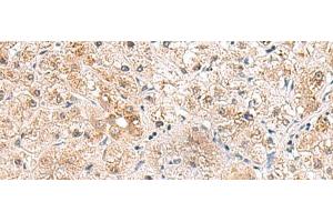 Immunohistochemistry of paraffin-embedded Human liver cancer tissue using RTKN2 Polyclonal Antibody at dilution of 1:75(x200) (RTKN2 antibody)