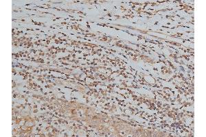 ABIN6267039 at 1/200 staining human breast cancer tissue sections by IHC-P. (Histone 3 antibody)
