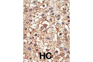 Formalin-fixed and paraffin-embedded human hepatocellular carcinoma tissue reacted with the PIAS4 polyclonal antibody  , which was peroxidase-conjugated to the secondary antibody, followed by DAB staining. (PIAS4 antibody  (N-Term))