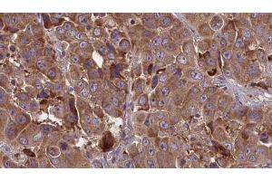 ABIN6273847 at 1/100 staining Human liver cancer tissue by IHC-P. (OR51J1 antibody)