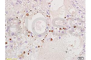 Formalin-fixed and paraffin embedded human ovary carcinoma labeled Anti-CDKN1B/P27kip1 Polyclonal Antibody, Unconjugated (ABIN672621) at 1:200, followed by conjugation to the secondary antibody and DAB staining