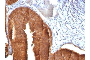 Formalin-fixed, paraffin-embedded human Bladder Carcinoma stained with Cytokeratin 19 Mouse Monoclonal Antibody (KRT19/800). (Cytokeratin 19 antibody)