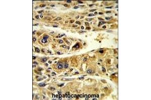 Formalin-fixed and paraffin-embedded human hepatocarcinoma reacted with ADH6 Antibody (Center), which was peroxidase-conjugated to the secondary antibody, followed by DAB staining. (ADH6 antibody  (AA 209-240))