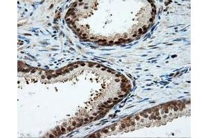 Immunohistochemical staining of paraffin-embedded Carcinoma of liver tissue using anti-LIPG mouse monoclonal antibody. (LIPG antibody)