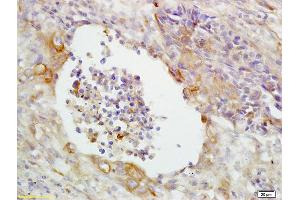 Formalin-fixed and paraffin embedded human lung carcinoma labeled with Anti-CD14 Polyclonal Antibody, unconjugated  (ABIN673164)  at 1: 200 followed by incubation with conjugated secondary antibody and DAB staining (CD14 antibody  (AA 201-300))
