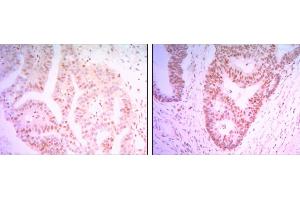 Immunohistochemical analysis of paraffin-embedded colon cancer tissues (left) and ovary cancer tissues (right) using THAP11 mouse mAb with DAB staining. (THAP11 antibody)