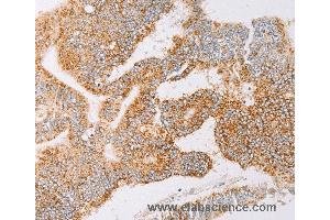 Immunohistochemistry of Human lung cancer using YARS2 Polyclonal Antibody at dilution of 1:30