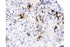 IHC analysis of Mast Cell Tryptase using anti-Mast Cell Tryptase antibody (ABIN4886754). (TPSAB1 antibody  (AA 65-275))