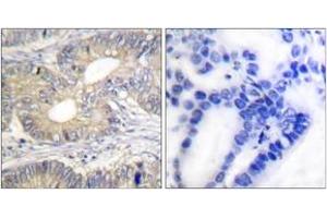Immunohistochemistry analysis of paraffin-embedded human colon carcinoma tissue, using Somatostatin Antibody. (Somatostatin antibody  (AA 10-59))