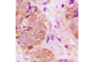 Immunohistochemical analysis of GSPT1 staining in human breast cancer formalin fixed paraffin embedded tissue section. (GSPT1 antibody)