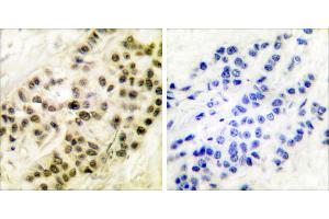 Peptide - +Immunohistochemical analysis of paraffin-embedded human breast carcinoma tissue using Cyclin B1 (Ab-126) antibody (#BOO68). (Cyclin B1 antibody  (Ser126))