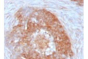 Formalin-fixed, paraffin-embedded human ovarian carcinoma stained with Fascin antibody (FSCN1/417) (Fascin antibody)