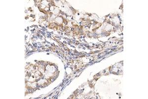 Immunohistochemistry of paraffin-embedded human lung cancer using Sterol carrier protein 2 Rabbit mAb (ABIN7270597) at dilution of 1:100 (40x lens).