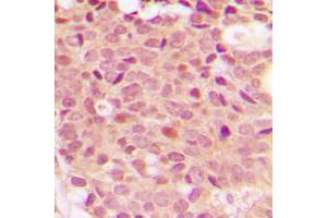Immunohistochemical analysis of Histone Deacetylase 5 (pS498) staining in human breast cancer formalin fixed paraffin embedded tissue section. (HDAC5 antibody  (pSer498))