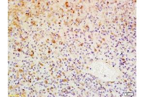 Formalin-fixed and paraffin embedded human glioma tissue labeled with Anti-WIG-1/PAG608 Polyclonal Antibody, Unconjugated  at 1:200, followed by conjugation to the secondary antibody and DAB staining (ZMAT3 antibody  (AA 201-288))