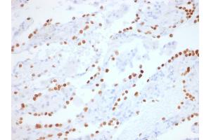 Formalin-fixed, paraffin-embedded human Lung Adenocarcinoma stained with TTF-1 Rabbit Recombinant Monoclonal Antibody (NX2. (Recombinant NKX2-1 antibody)