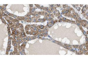 ABIN6269118 at 1/100 staining Human liver cancer tissue by IHC-P. (IGF1R antibody  (C-Term))