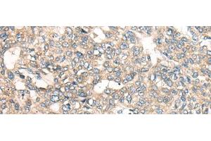 Immunohistochemistry of paraffin-embedded Human liver cancer tissue using LRP1B Polyclonal Antibody at dilution of 1:50(x200) (LRP1B antibody)