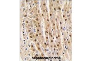 Formalin-fixed and paraffin-embedded human hepatocarcinoma tissue reacted with GDH antibody (N-term), which was peroxidase-conjugated to the secondary antibody, followed by DAB staining. (GAPDH antibody  (N-Term))