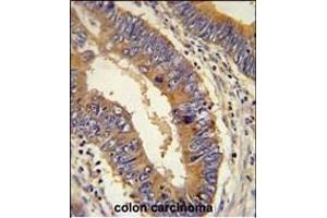 DHX58 Antibody (N-term) (ABIN651621 and ABIN2840330) immunohistochemistry analysis in formalin fixed and paraffin embedded human colon carcinoma followed by peroxidase conjugation of the secondary antibody and DAB staining. (DHX58 antibody  (N-Term))