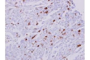 IHC-P Image HLA-DRA antibody detects HLA-DRA protein at membrane on human Leukocytes in liver carcinoma by immunohistochemical analysis.