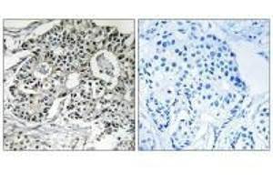 Immunohistochemistry analysis of paraffin-embedded human breast carcinoma tissue using PXMP2 antibody. (PXMP2 antibody)