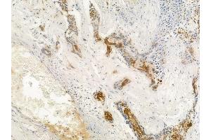 ABIN6262776 and ABIN6266570 at 1/100 staining human breast carcinoma by IHC-P.
