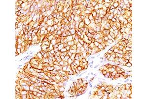 Formalin-paraffin human renal cell carcinoma stained with CAIX antibody (66. (CA9 antibody)