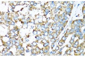 Immunohistochemistry of paraffin-embedded Human liver cancer using COX6A1 Polyclonal Antibody at dilution of 1:100 (40x lens). (COX6A1 antibody)
