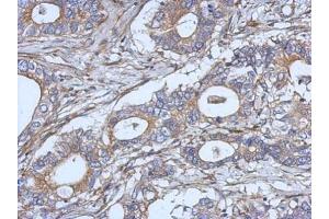 IHC-P Image Immunohistochemical analysis of paraffin-embedded human gastric cancer, using IL2, antibody at 1:500 dilution. (IL-2 antibody)