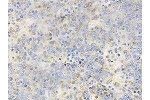 ABIN6256653 and ABIN6267393 at 1/100 staining human melanoma by IHC-P. (VAV1 antibody  (pTyr174))