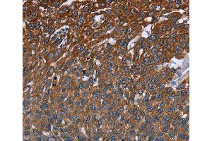 Immunohistochemistry of Human cervical cancer using FCGR3A Polyclonal Antibody at dilution of 1:40 (FCGR3A antibody)