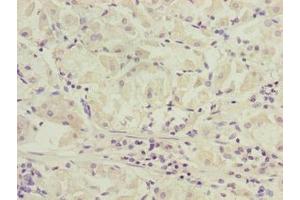 Immunohistochemistry of paraffin-embedded human gastric cancer using ABIN7170271 at dilution of 1:100 (GPR172B antibody  (AA 212-279))