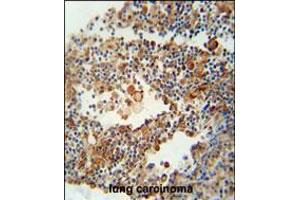 OR9Q1 antibody immunohistochemistry analysis in formalin fixed and paraffin embedded human lung carcinoma followed by peroxidase conjugation of the secondary antibody and DAB staining. (OR9Q1 antibody  (C-Term))