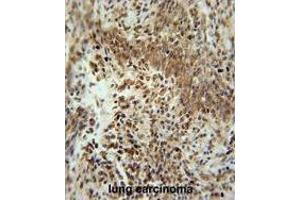ZNF667 Antibody (Center) immunohistochemistry analysis in formalin fixed and paraffin embedded human lung carcinoma followed by peroxidase conjugation of the secondary antibody and DAB staining. (ZNF667 antibody  (Middle Region))