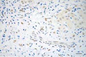 Immunohistochemistry was performed on paraffin-embedded human hepatocarcinoma using CSE1L like antibody (ABIN7798171), 1:200).